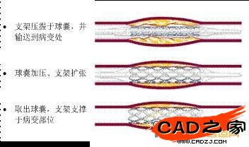 支架植入过程示意图